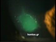 Απόπτωση του επιθηλίου του κερατοειδούς όπως φαίνεται στο μικροσκόπιο με χρήση ειδικής χρωστικής. 1