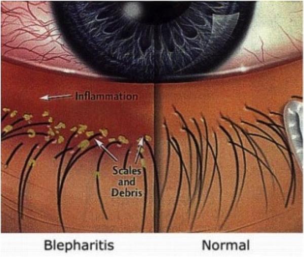 Η βλεφαρίτιδα