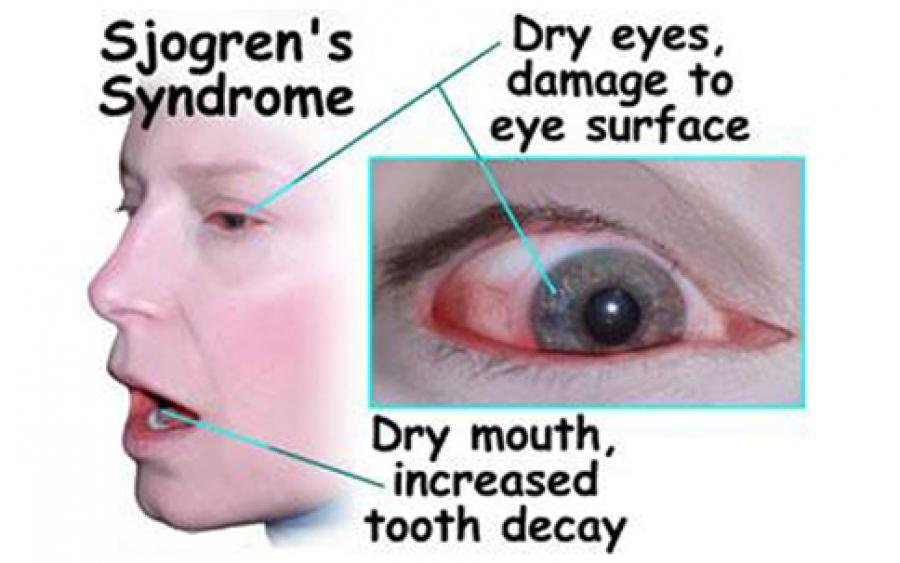 Τι είναι το σύνδρομο Sjogren και πως αντιμετωπίζεται